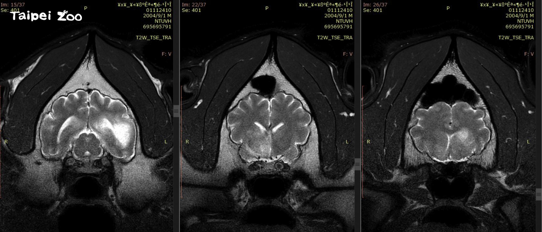 大貓熊「團團」第2次MRI(磁振造影)檢查結果，病灶區域明顯擴大