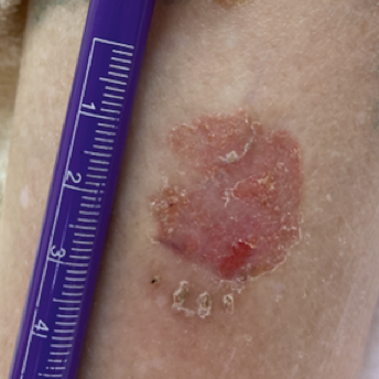 皮膚惡性腫瘤-鱗狀細胞癌(照片由劉康玲醫師提供).png