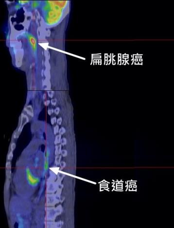 正子攝影顯示同時有扁朓腺癌及食道癌(賴建仲醫師提供)