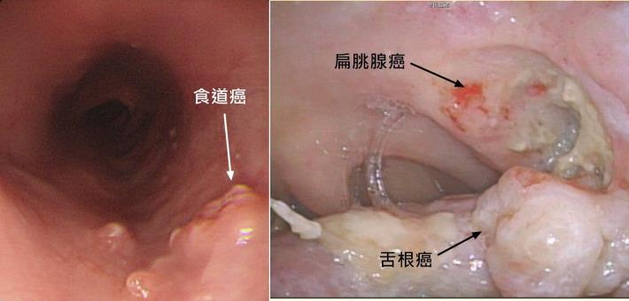 內視鏡-食道癌、扁朓腺癌及舌根癌(賴建仲醫師提供)