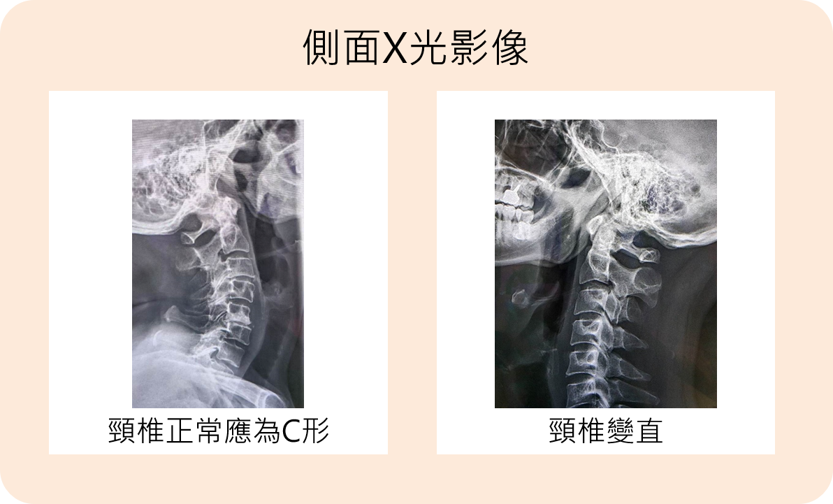 側面X光影像(圖片由武俊傑主任提供)