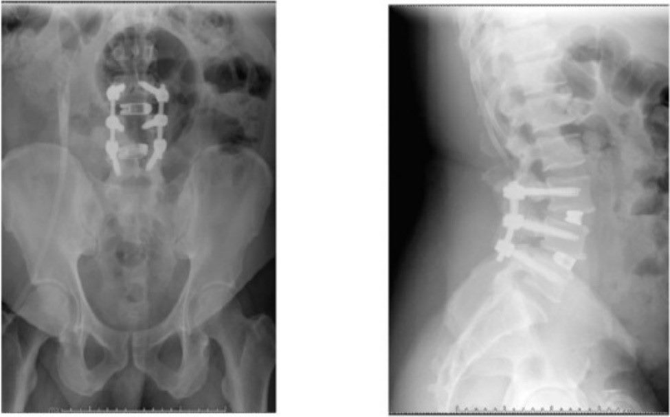 術後照-椎弓鋼釘置入、減壓及支架置入(圖片來源為國際外科雜誌)