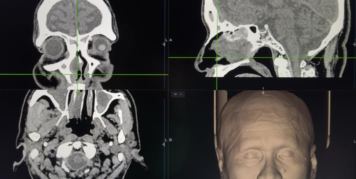3D立體定位導航手術 示意照片2(照片由朱峻緯醫師提供)