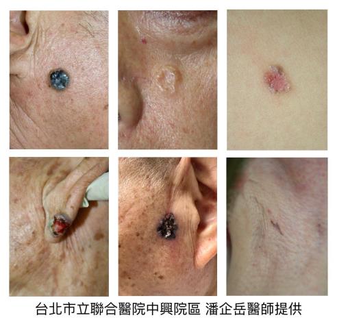 1140918-1(照片由潘企岳醫師提供)