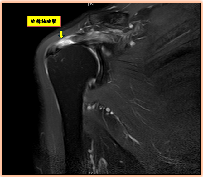 旋轉袖破裂(圖片由陳昱彰醫師提供)