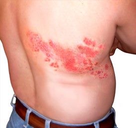 帶狀皰疹病毒患部（圖像版權屬於A.D.A.M.醫學資訊圖庫）