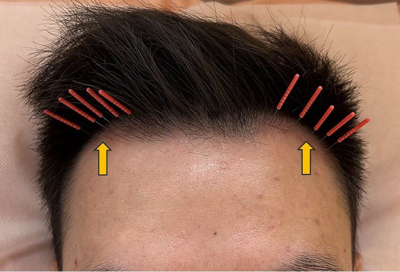 美顏針治療頭髮稀疏。