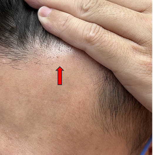 治療前：前額頭髮稀疏(圖片由林在裕主任提供)