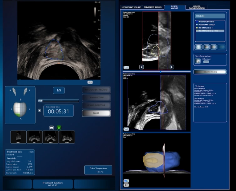 新一代海扶刀結合MRI核磁共振和即時超音波影像，提供多元的客製化治療方案精準局部摧毀癌細胞(圖片由徐易廷醫師提供)