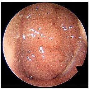 1150205-1-腺樣體肥大(第四級)(圖片由網路截取)