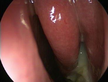 1150205-1-慢性鼻竇炎內視鏡(圖片由網路截取)