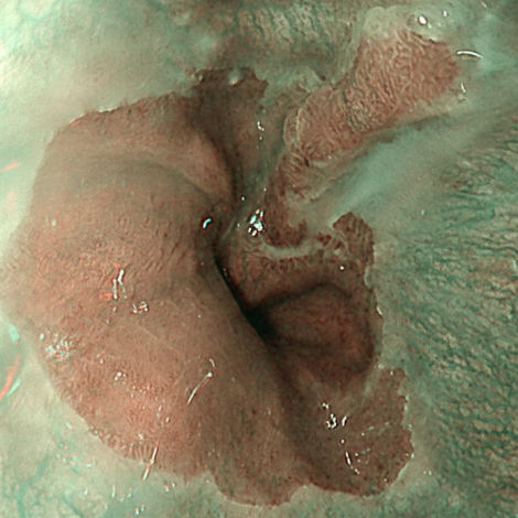 1150205-2-胃鏡發現胃食道逆流