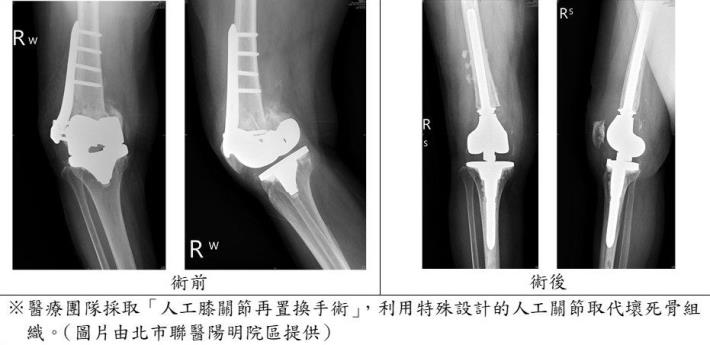手術前後(圖片由北市聯醫陽明院區提供)