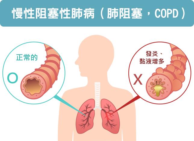 慢性阻塞性肺病(圖片由北市聯醫繪製)