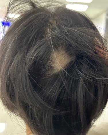 圓禿是一種自體免疫疾病,當免疫系統異常活化,將毛囊誤認為外來物而加以攻擊時,便可能造成局部毛髮突然脫落(照片由蔡和熹醫師提供)