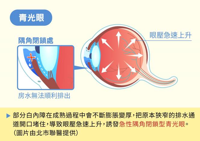 青光眼(圖片由北市聯醫提供)