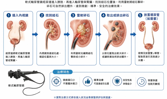 軟式輸尿管鏡碎石治療方法(AI生成圖由賴明志醫師提供)