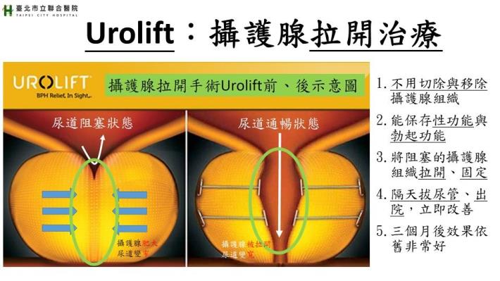 Urolift 示意圖