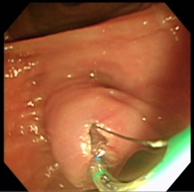 膽道結石症診斷與內視鏡膽道截石術治療2