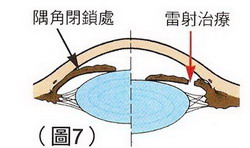 臺北市立聯合醫院仁愛院區 眼科 青光眼