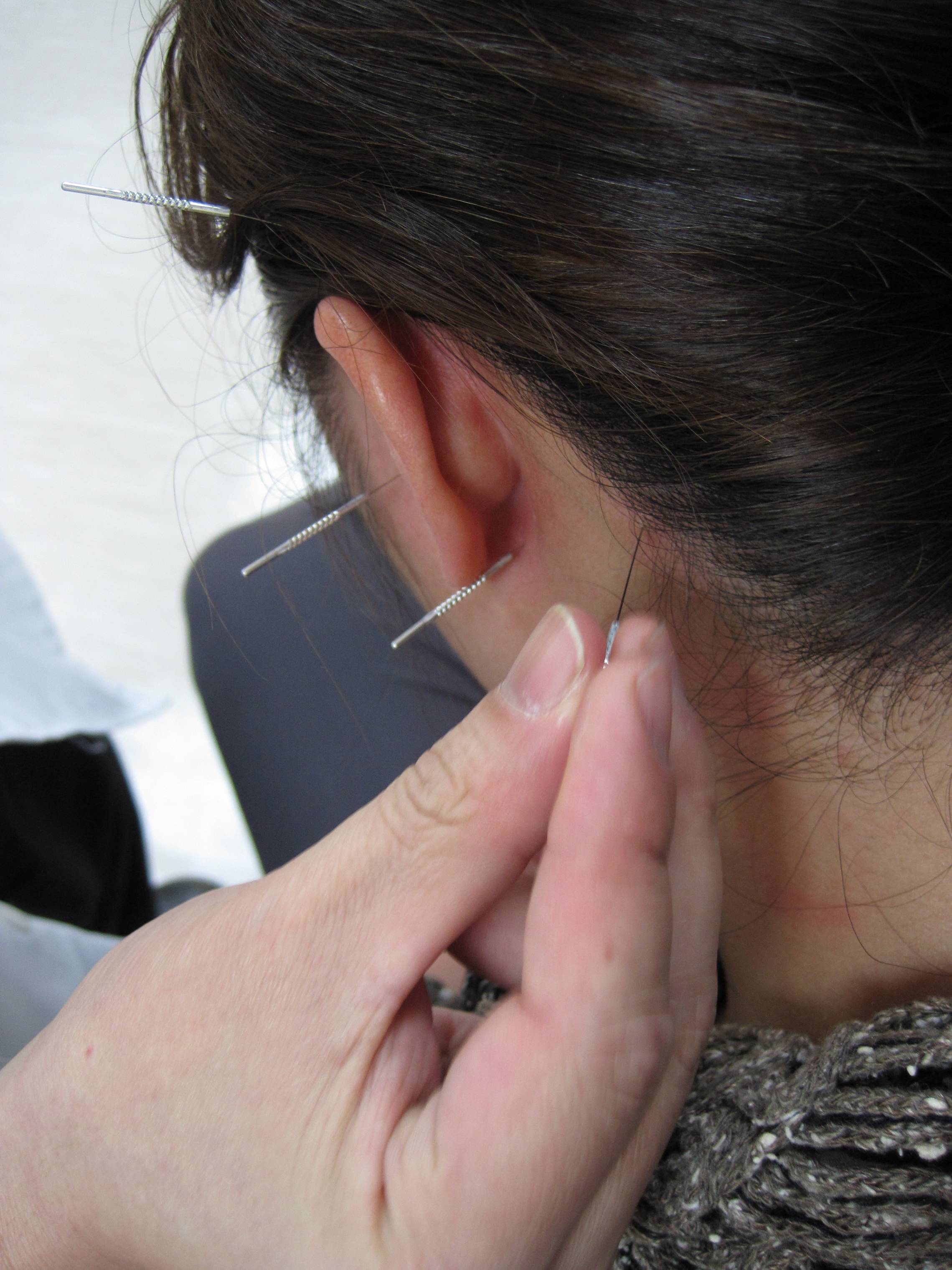 Acupuncture
