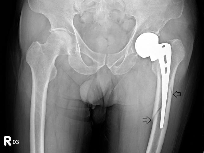 箭頭指向第二次跌倒造成的左側股骨在人工關節周圍的移位性骨折