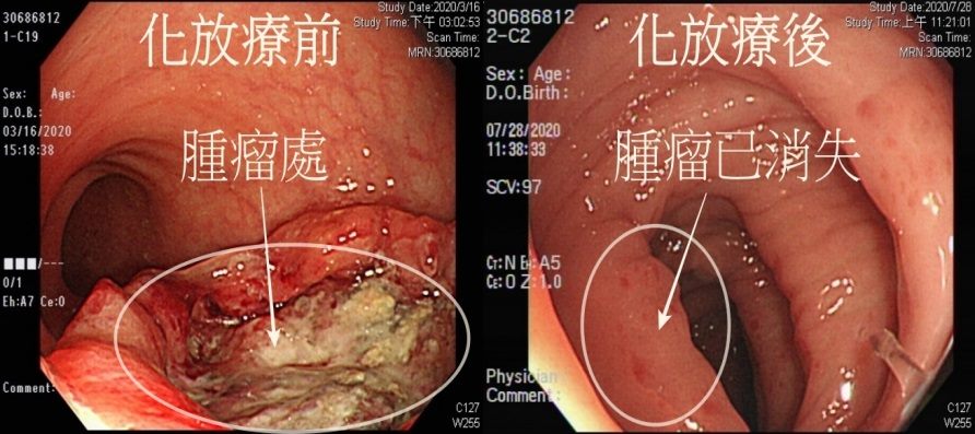 大腸鏡檢查化放療前後