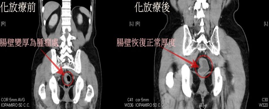 電腦斷層影像檢查化放療前後-2