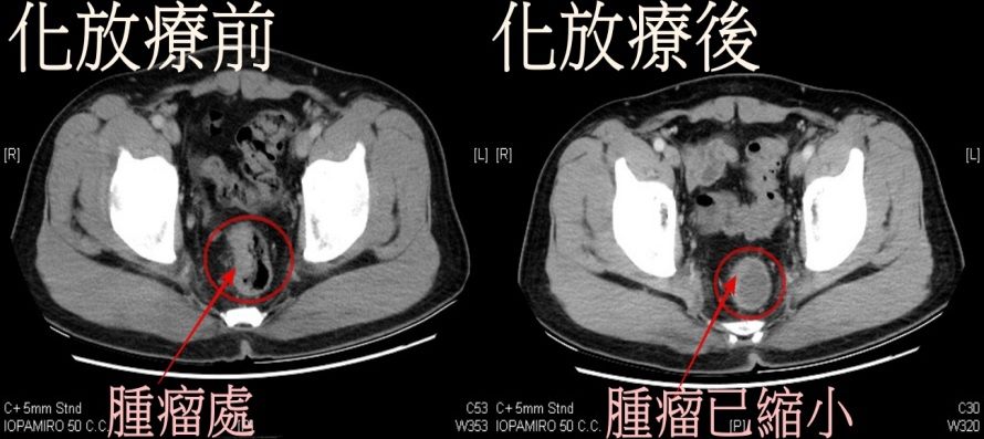 電腦斷層影像檢查化放療前後