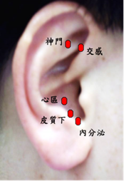 醫師將耳穴貼壓膠布貼在特定的耳穴上，經過適當的耳穴按摩即可發揮助眠、降壓療效。