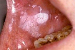 口腔頰黏膜白斑病變