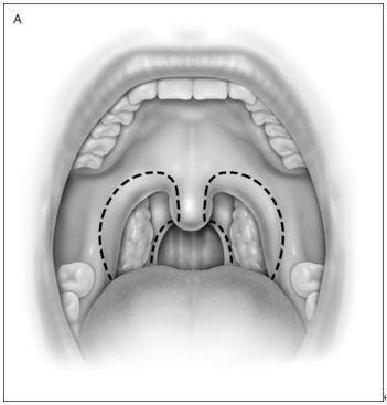 懸壅垂顎咽整形術